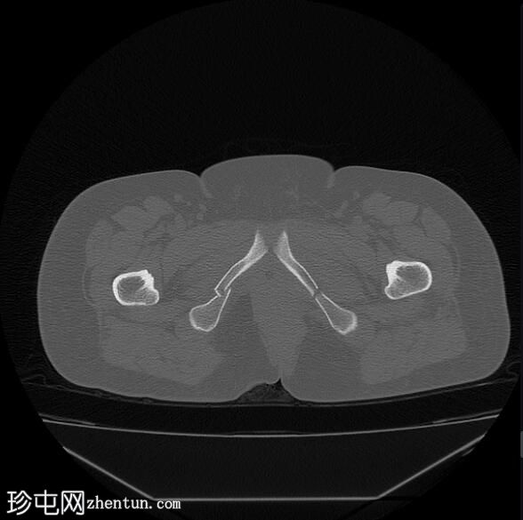 骨盆环侧方压缩骨折