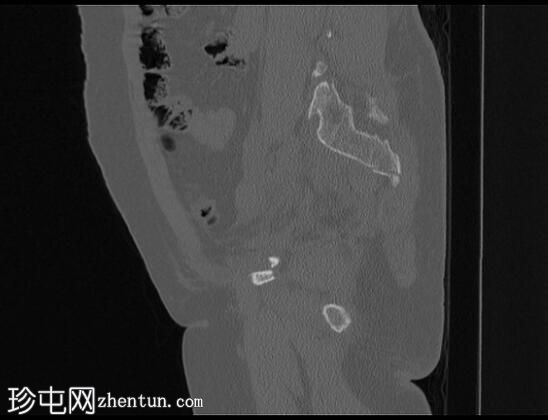 骨盆环侧方压缩骨折