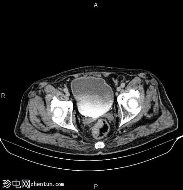 转移性直肠腺癌