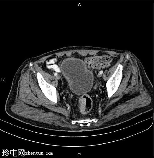 转移性直肠腺癌