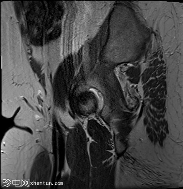 正常女性骨盆MRI（子宫前倾）