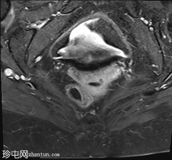 正常女性骨盆MRI（子宫前倾）