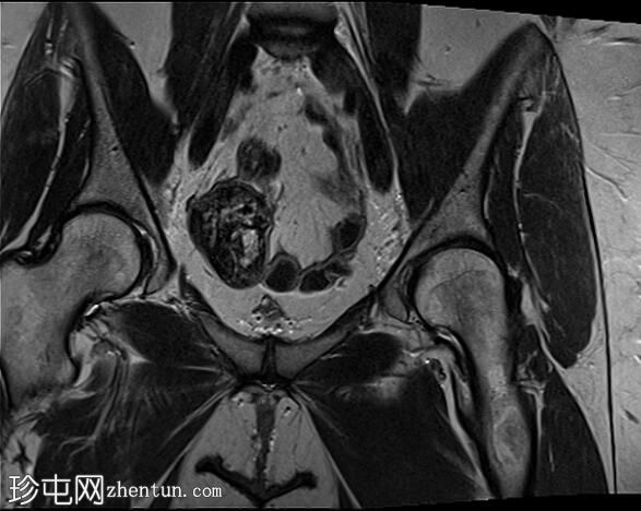 正常女性骨盆MRI（子宫前倾）