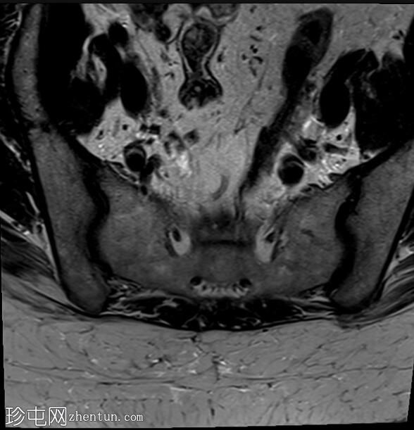 正常女性骨盆MRI（子宫前倾）