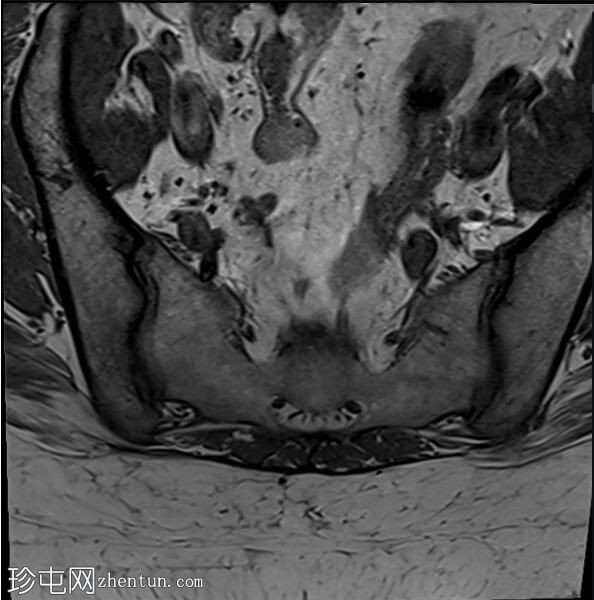 正常女性骨盆MRI（子宫前倾）