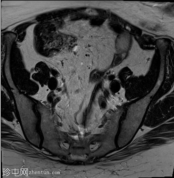 正常女性骨盆MRI（子宫前倾）