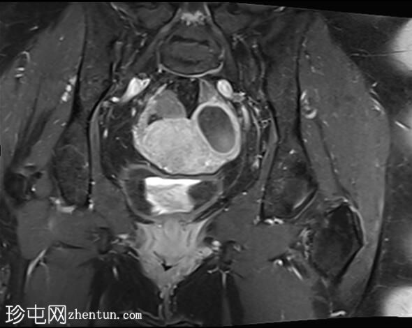 正常女性骨盆MRI（子宫前倾）