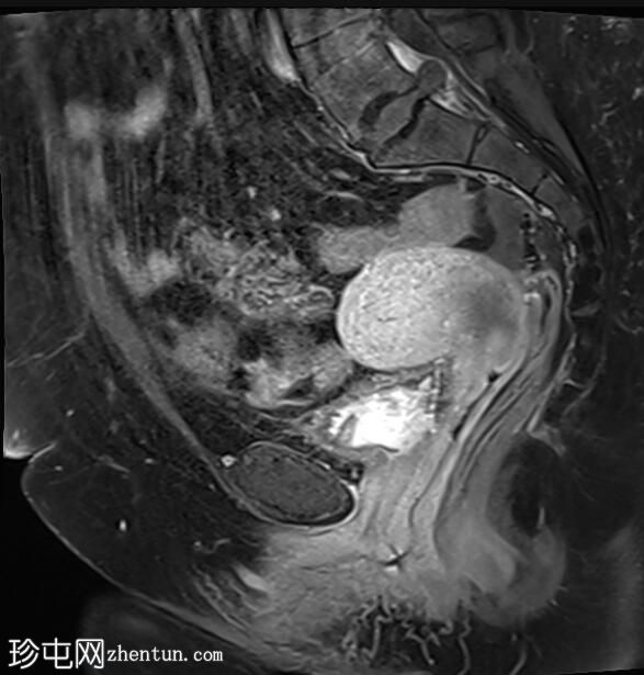 正常女性骨盆MRI（子宫前倾）