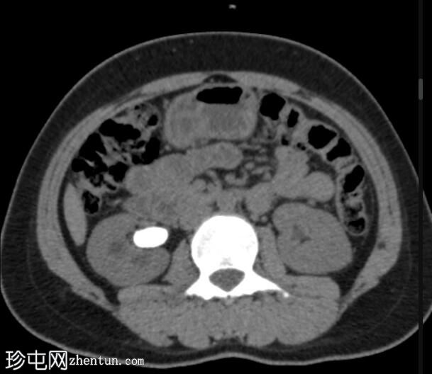 肾盂结石