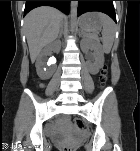 肾盂结石
