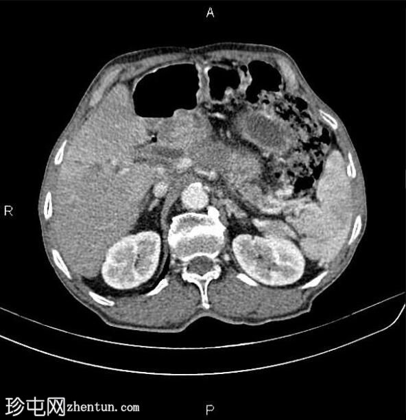 胰腺导管腺癌