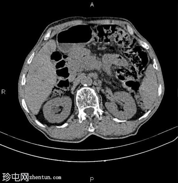 胰腺导管腺癌