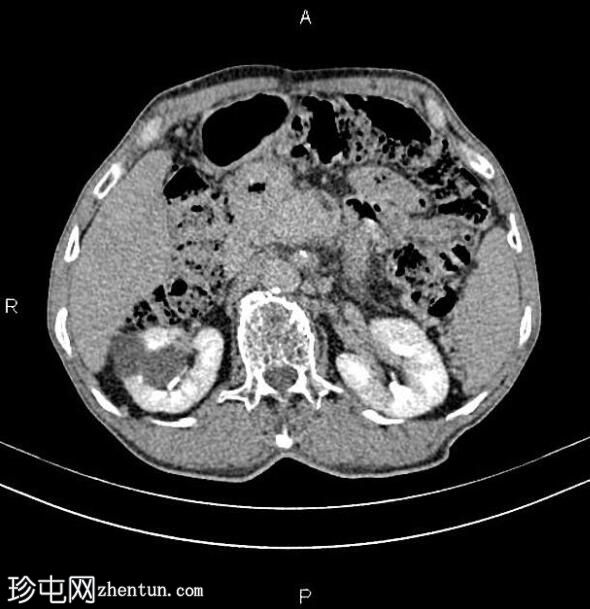 胰腺导管腺癌