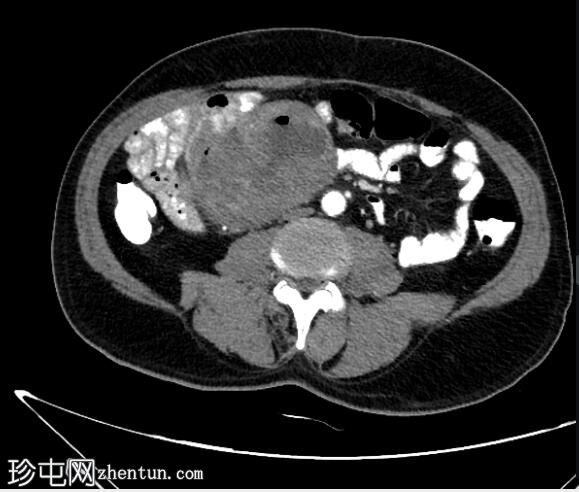 胃肠道间质瘤（GIST）