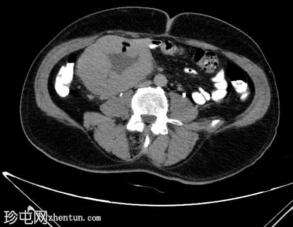 胃肠道间质瘤（GIST）