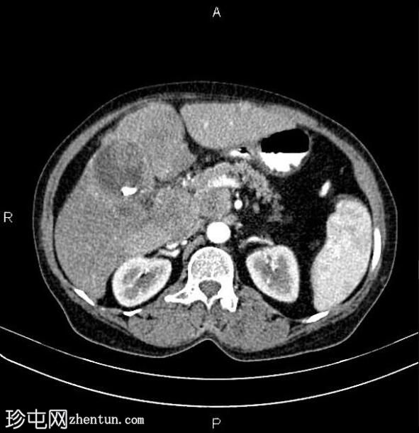 转移性胆囊腺癌