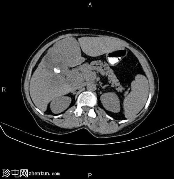 转移性胆囊腺癌