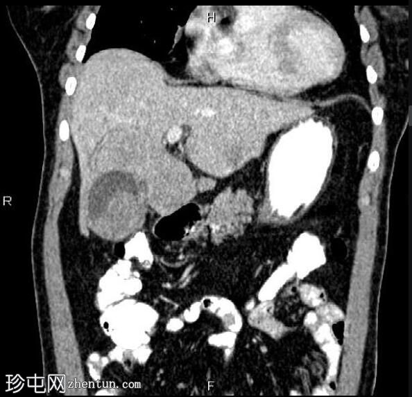 转移性胆囊腺癌