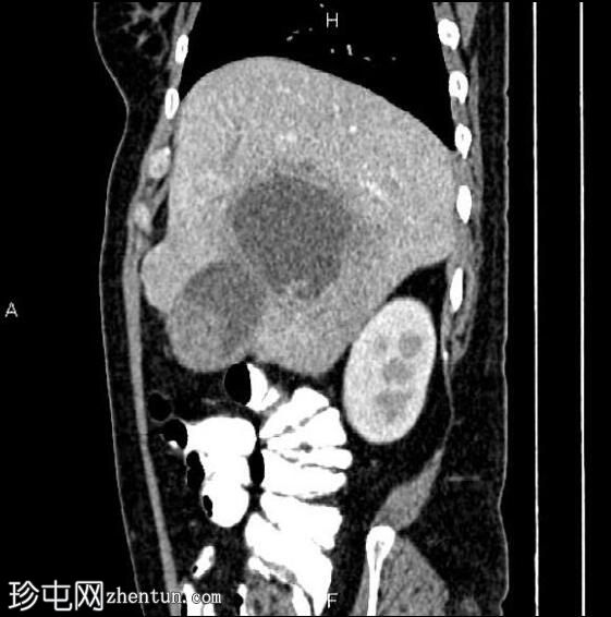 转移性胆囊腺癌