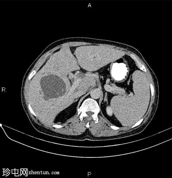 转移性胆囊腺癌