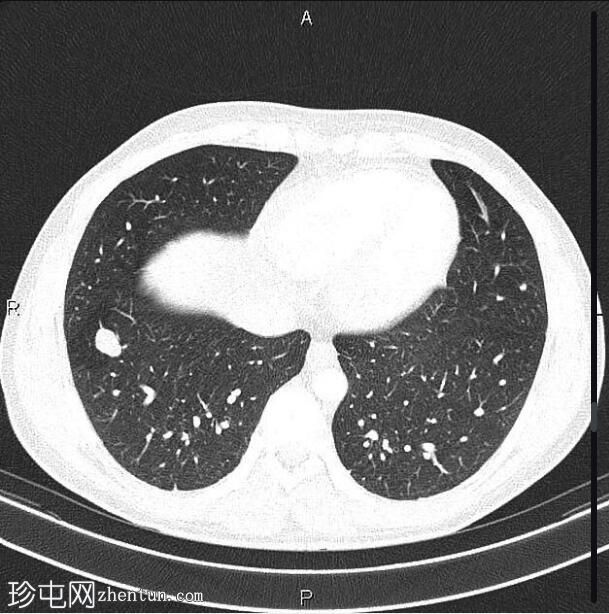 转移性睾丸生殖细胞肿瘤