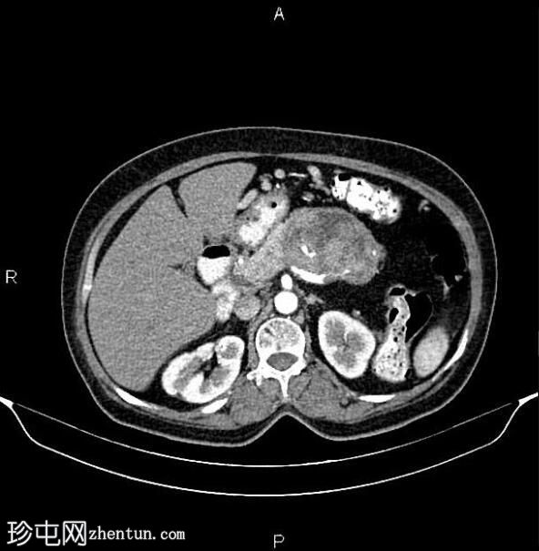 胰腺粘液性囊腺癌