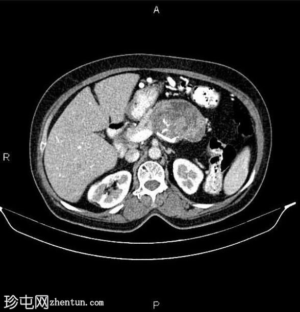 胰腺粘液性囊腺癌