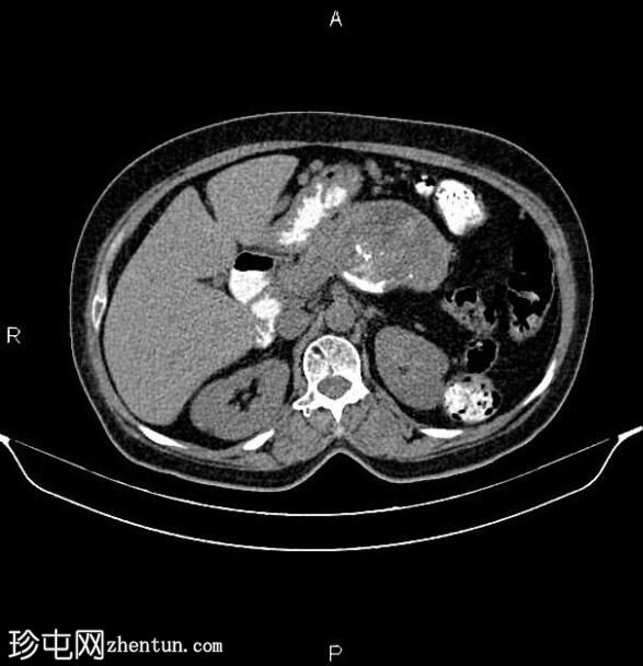 胰腺粘液性囊腺癌