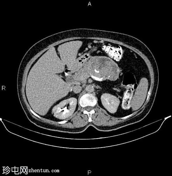 胰腺粘液性囊腺癌