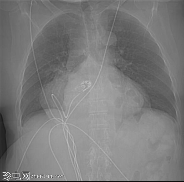 食管裂孔疝 - IV 型