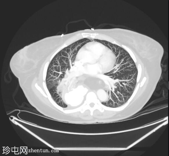 食管裂孔疝 - IV 型