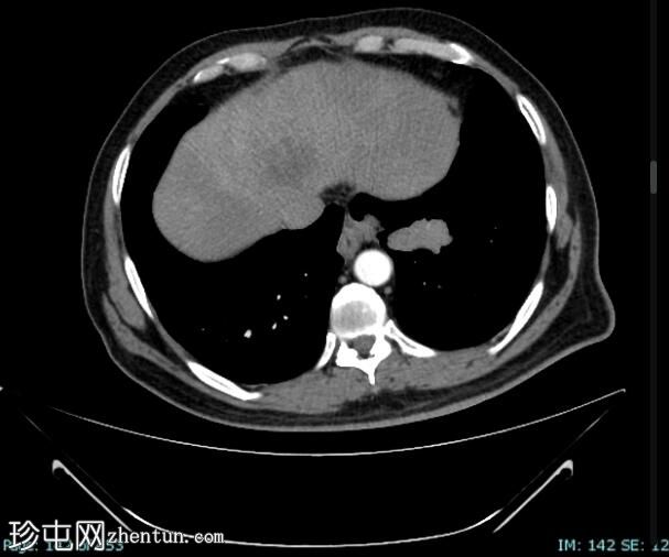 肺小细胞癌转移至肝脏
