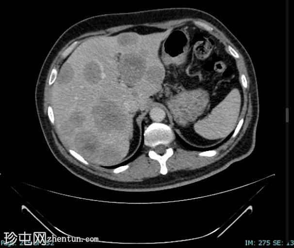 肺小细胞癌转移至肝脏
