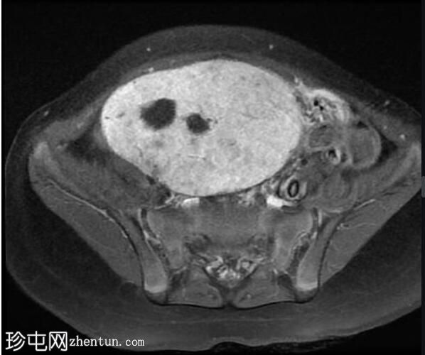 卵巢幼年型颗粒细胞瘤