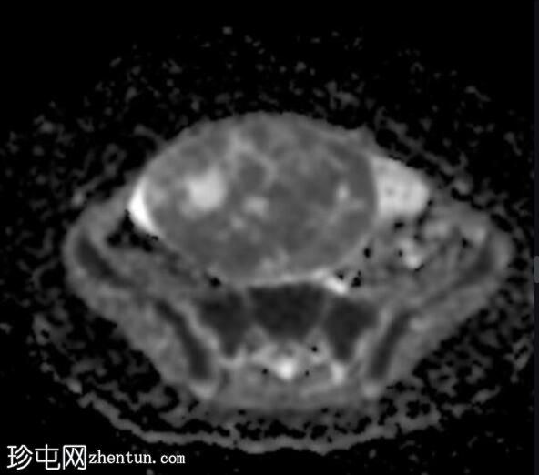 卵巢幼年型颗粒细胞瘤