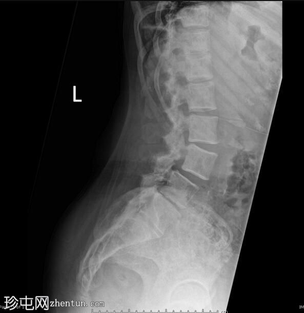 骨髓纤维化