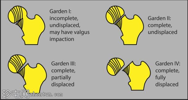 Garden I型股骨颈骨折