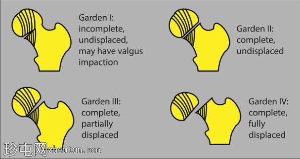 Garden IV股骨颈骨折