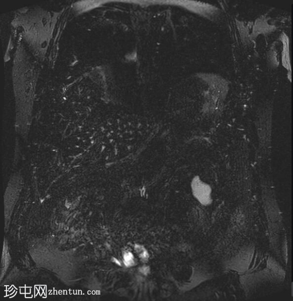 胆囊腺肌瘤病