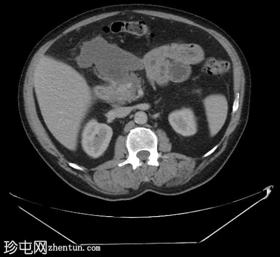 胰腺围壁坏死