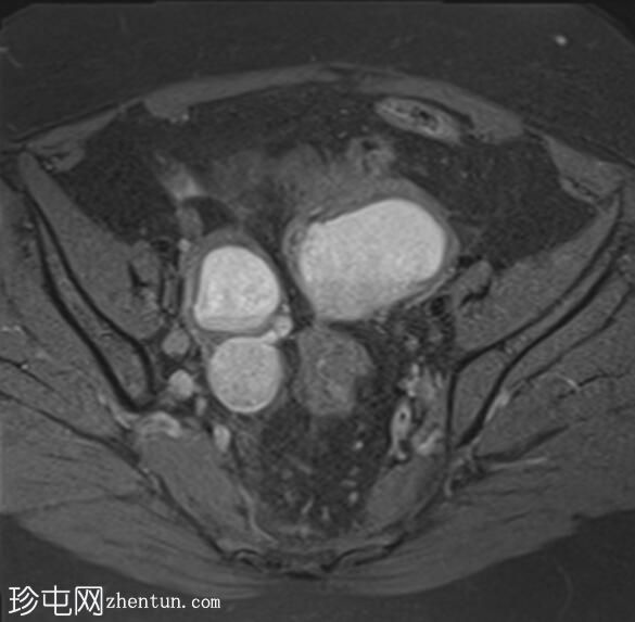 深部浸润性子宫内膜异位症——三叶草征