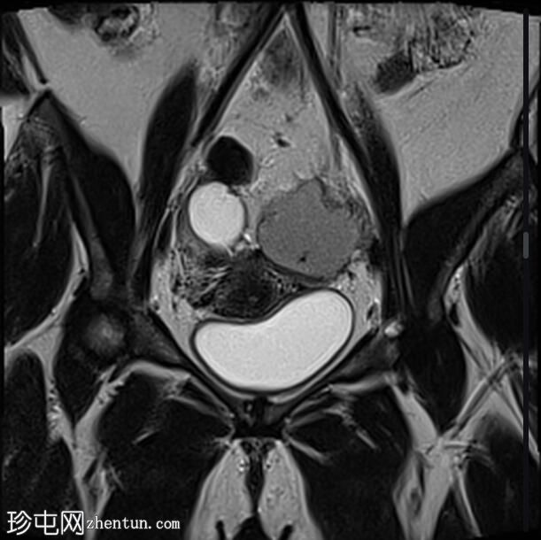 深部浸润性子宫内膜异位症——三叶草征