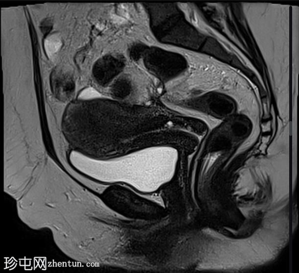 深部浸润性子宫内膜异位症——三叶草征