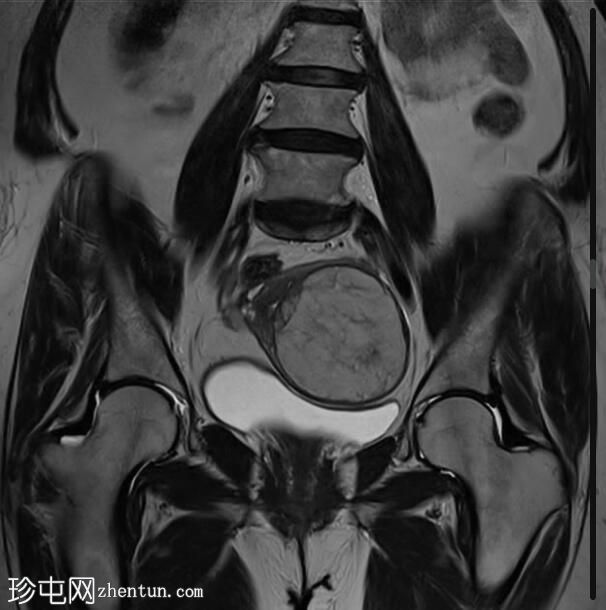 子宫脂肪肌瘤