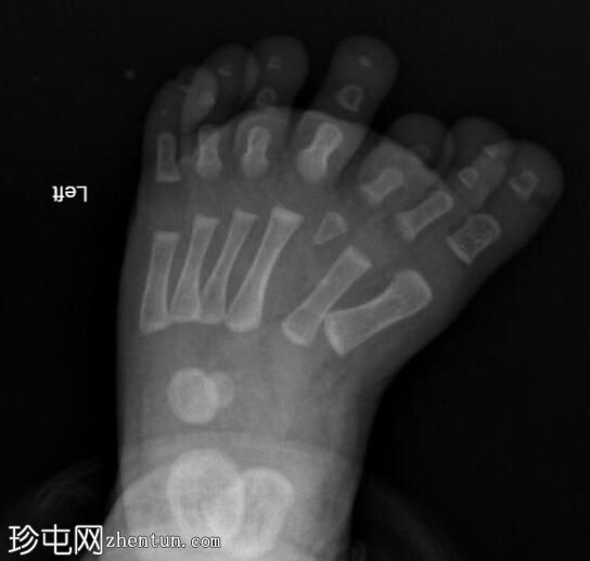 中央足六指畸形