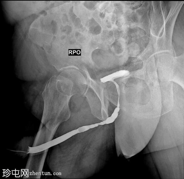 球部尿道狭窄