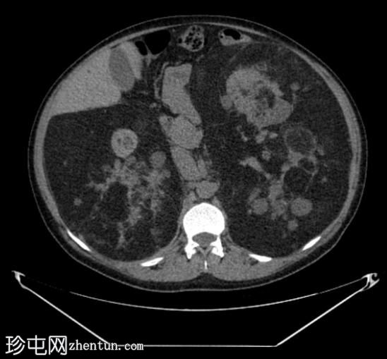 结节性硬化症患者的巨大肾血管平滑肌脂肪瘤