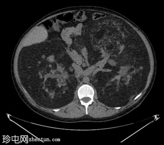 结节性硬化症患者的巨大肾血管平滑肌脂肪瘤