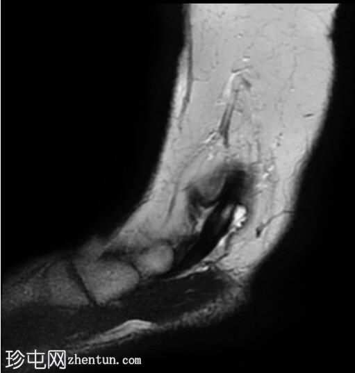 胫骨后肌间质撕裂