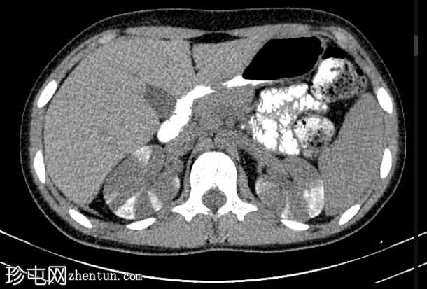 横纹肾图